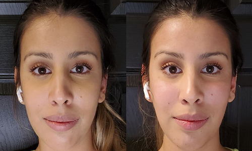 dermal filler cheek enhancement before after mississauga oakville